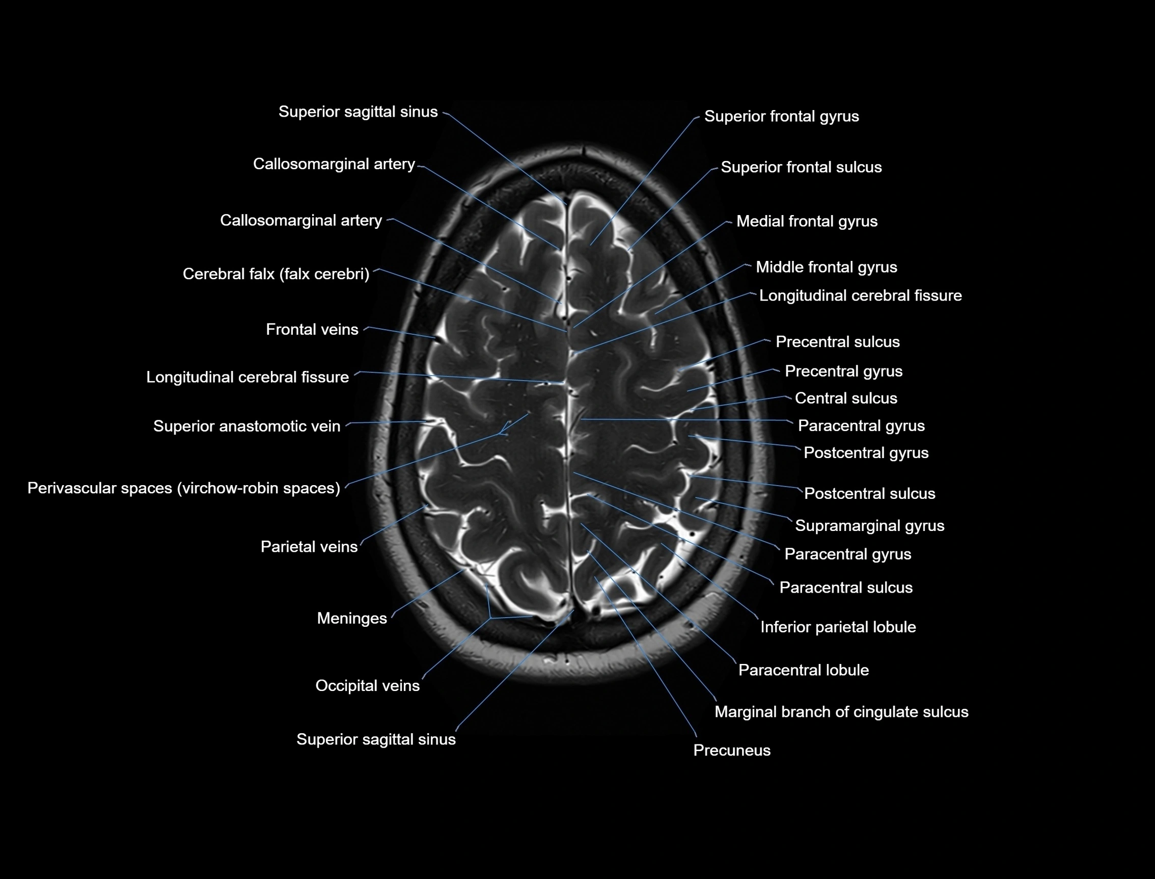MRI Brain axial cross sectional radiology anatomy 3T image  -img-00001-00047.webp